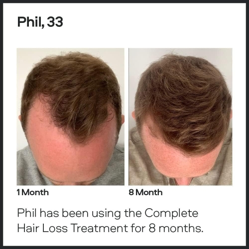 Sons Minoxidil 5% Cutaneous Solution - Hair Regrowth & Thickener Formula - For Hair Loss & Thinning in Men - Reactivates Shrunken Follicles - Precision Application System - 3 Month Supply - Image 7